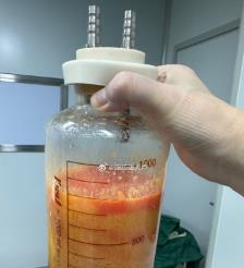 开原水动力吸脂手术要做多久？